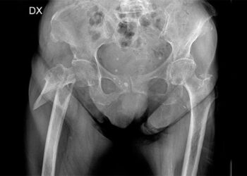 Il miracolo della sanità che non c’è, nuovo intervento Laser per frattura di Femore