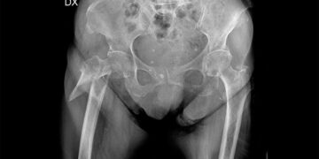 Il miracolo della sanità che non c’è, nuovo intervento Laser per frattura di Femore