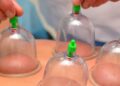 L’Hijama come esempio di medicina islamica: cos’è e come funziona