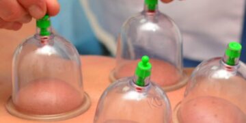 L’Hijama come esempio di medicina islamica: cos’è e come funziona