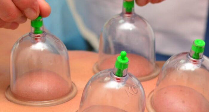 L’Hijama come esempio di medicina islamica: cos’è e come funziona