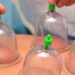 L’Hijama come esempio di medicina islamica: cos’è e come funziona